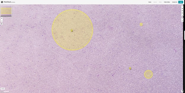 An example of a virtual blood smear in PreciCloud scanned at 100x