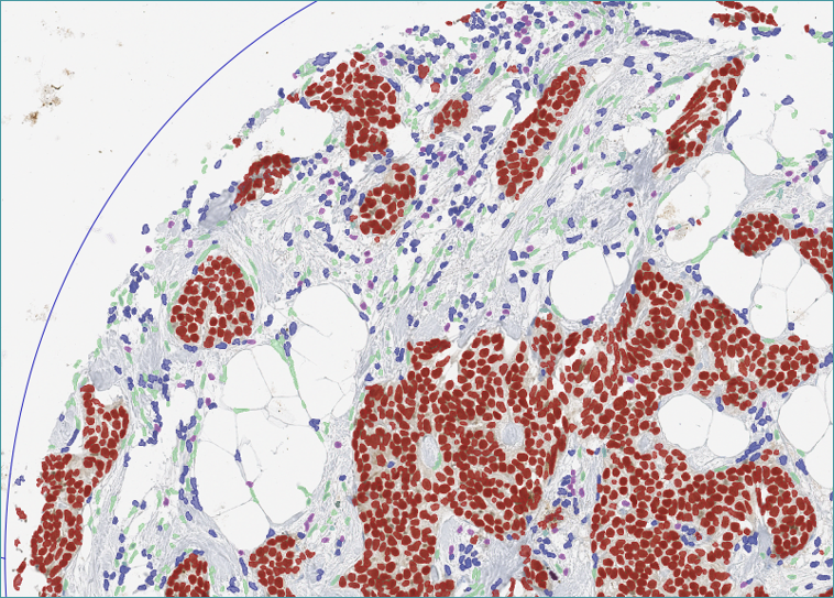 The AI marks lymphocytes and differentiates tumor cells from stroma within minutes